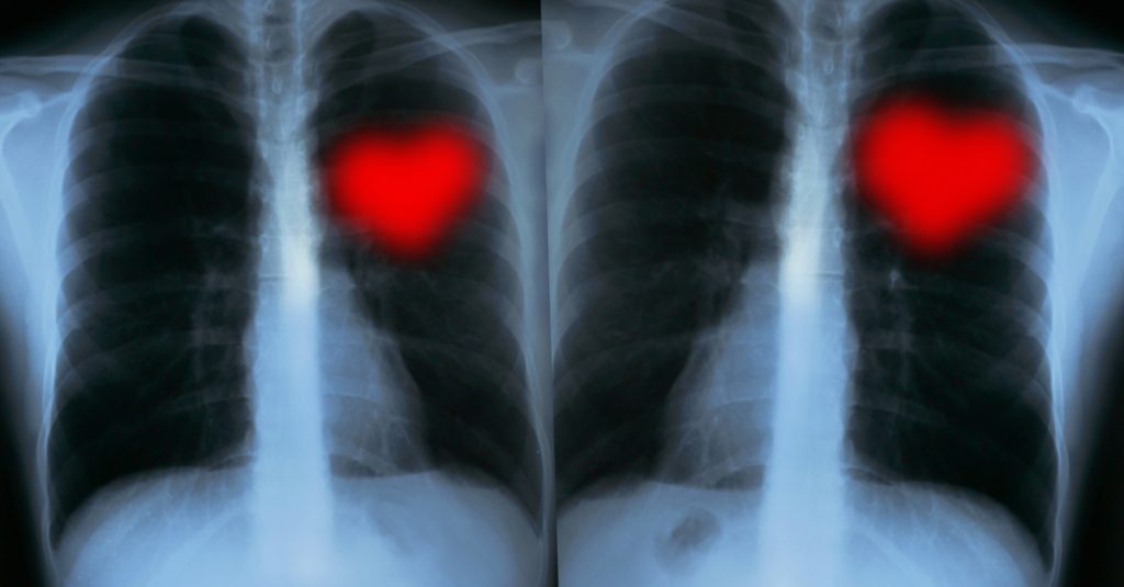 Valentines X-Rays – Love hearts | Ascent CardiologyAscent Cardiology
